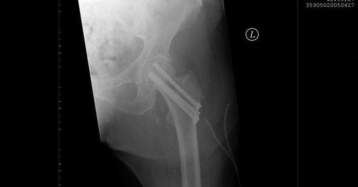 Bei dieser Röntgenaufnahme wurde der Schenkelbruch mit Schrauben fixiert. Quelle: wikipedia/user:&nbsp;Sjoehest