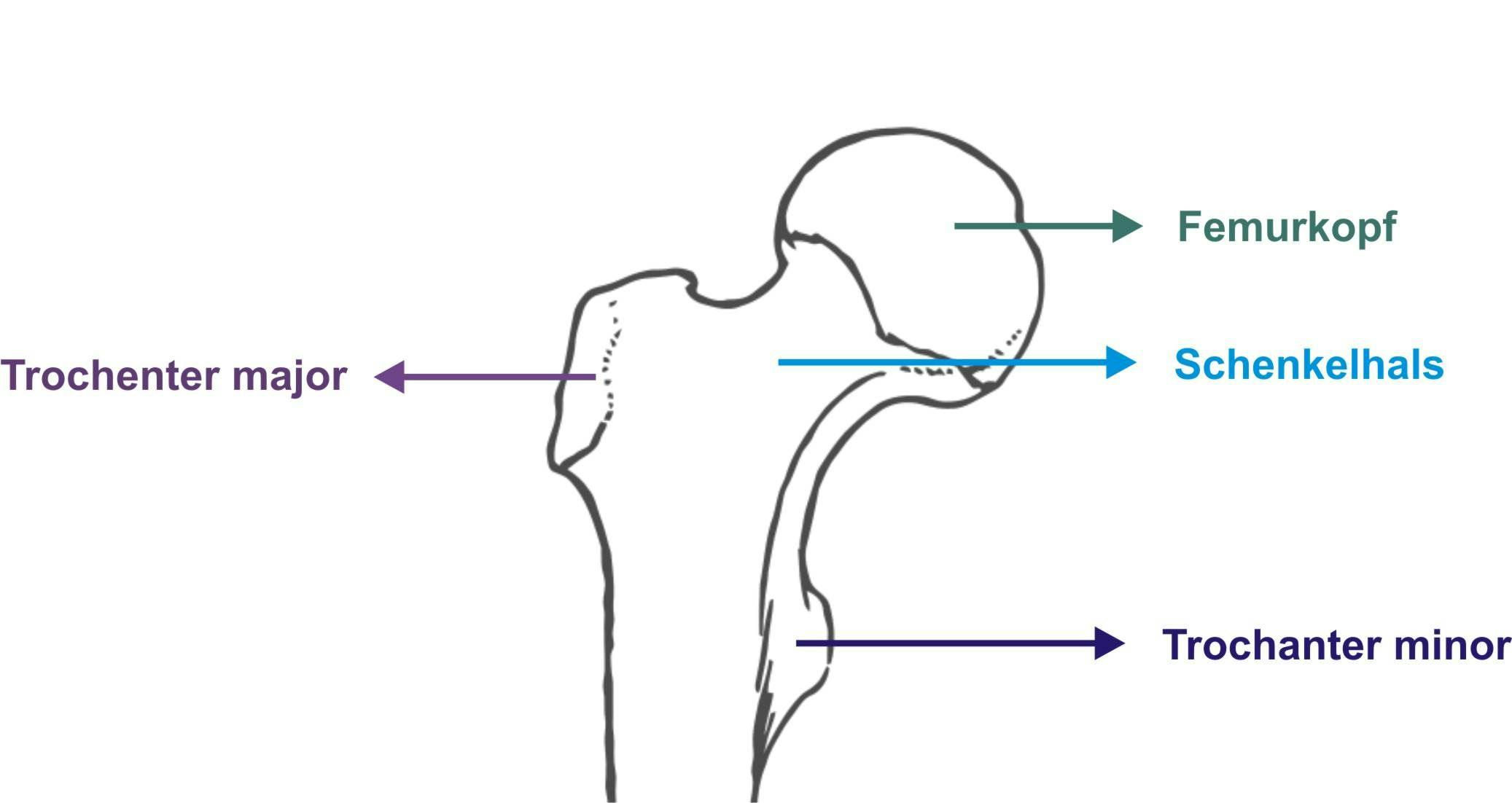 Die Anatomie eines Schenkelhalses. Bildquelle:&nbsp;OrthoPat/wikipedia&nbsp;