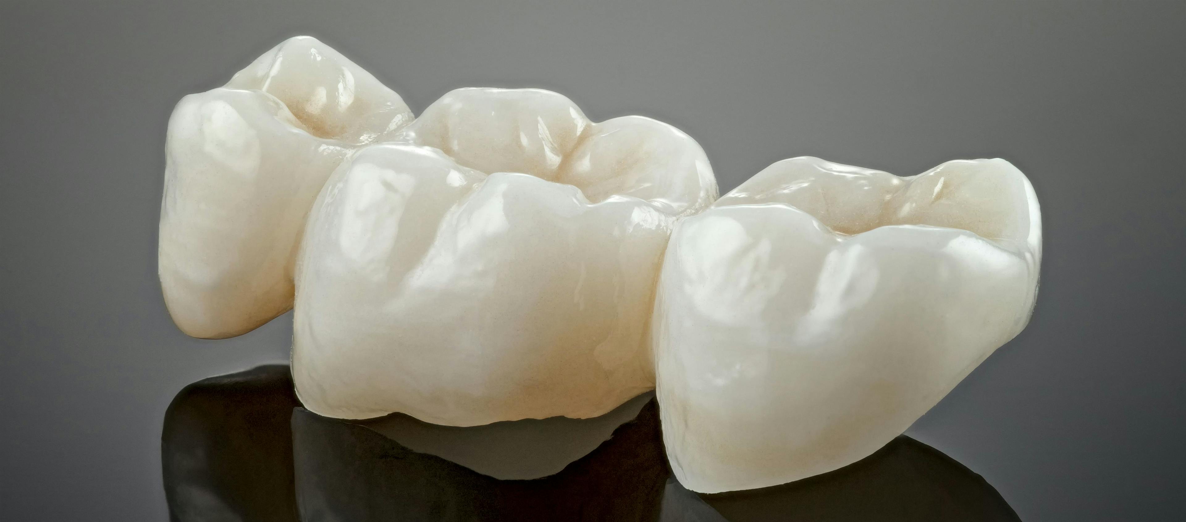 Eine Zahnkrone aus Keramik. Optisch unterscheidet sie sich kaum von richtigen Zähnen.&nbsp;