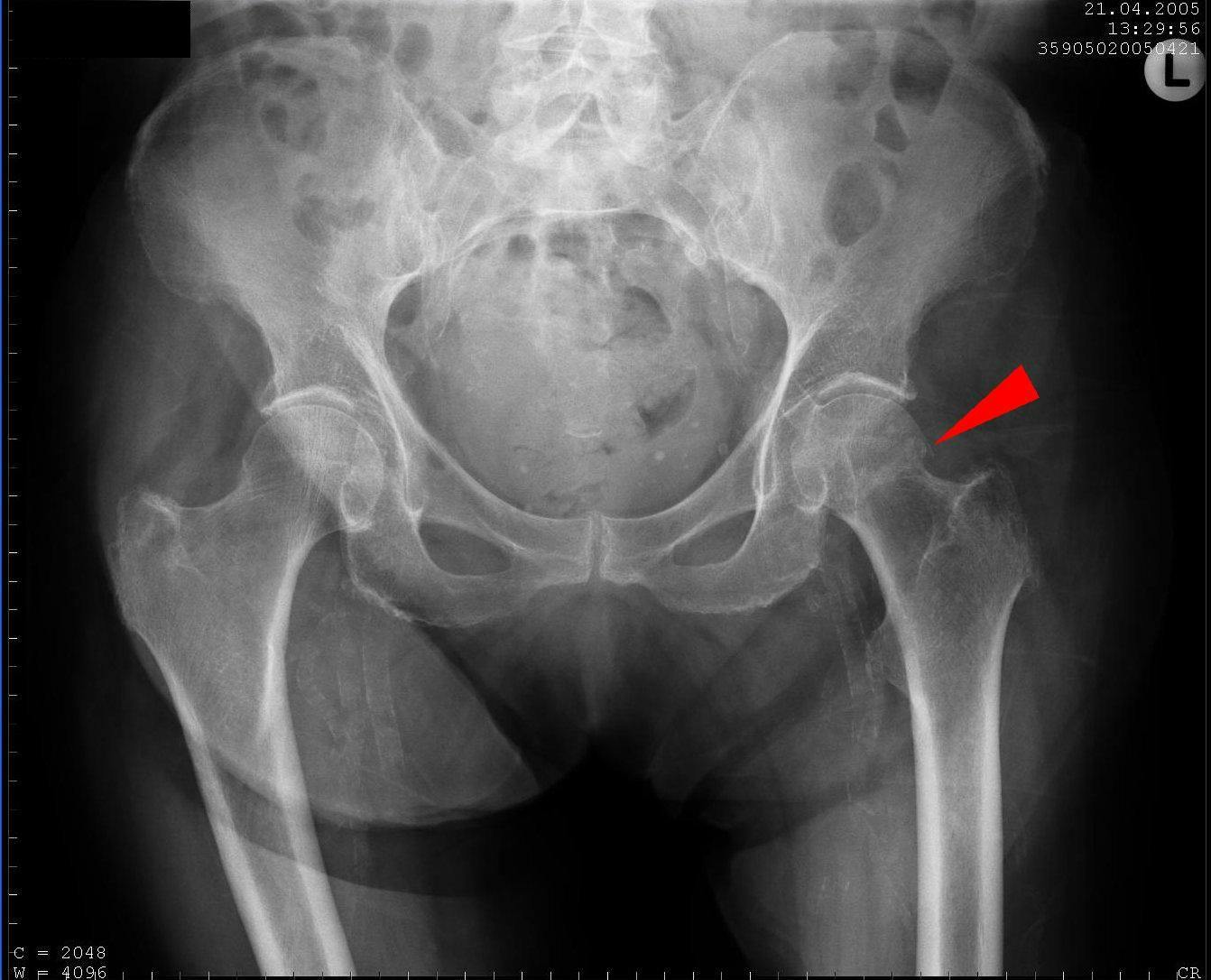 Diese Röntgenaufnahme zeigt eine mediale Schenkelhalsfraktur ohne Verschiebung oder Verdrehung (siehe roter Pfeil). Quelle: wikipedia/Sjoehest