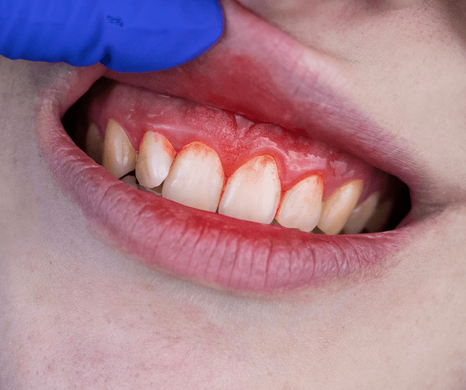 Blutendes Zahnfleisch kann Symptom einer beginnenden Parodontose sein.&nbsp;